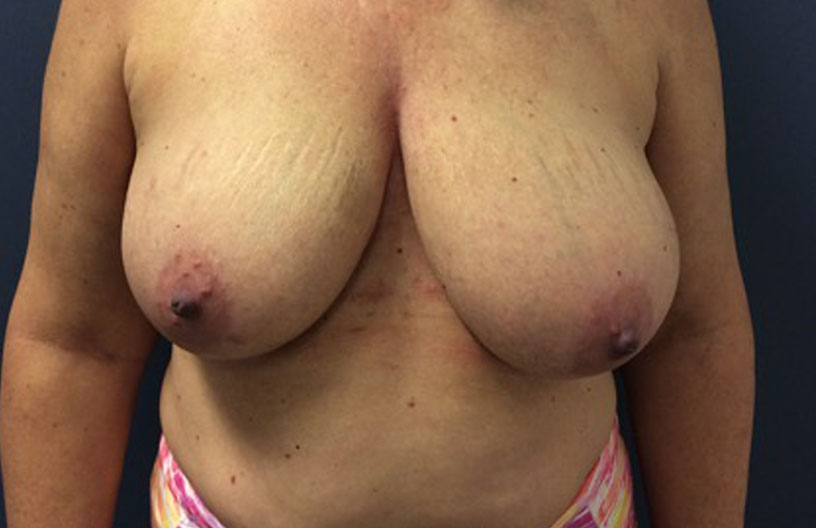 Breast Reconstruction