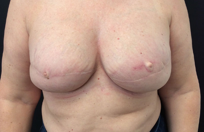 Breast Reconstruction